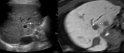 Image Guidance in Ablation for Hepatocellular Carcinoma: Contrast-Enhanced Ultrasound and Fusion Imaging